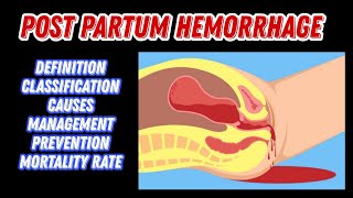 Post Partum Hemorrhage  Causes Classification Treatment  PPH  MisMedicine [upl. by Trueman]