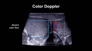 Diagnosing testicular torsion [upl. by Tullius184]