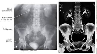 Retrograde pyelography using a dual lumen catheter [upl. by Maire53]