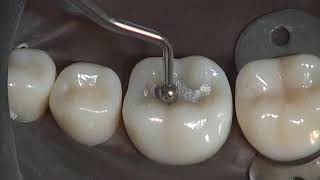 Class I Amalgam Preparation amp Restoration  Operative Dentistry [upl. by Ninon751]