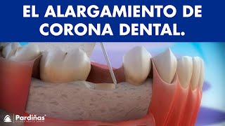 Alargamiento de corona dental © [upl. by Nwaf]