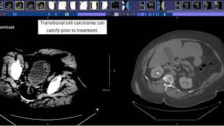 CT Urogram [upl. by Iral898]