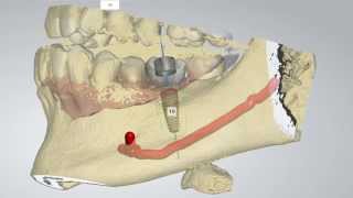 Digital Implant Dentistry [upl. by Ivor]