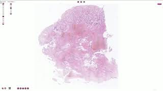 Choriocarcinoma  Histopathology [upl. by Handal707]