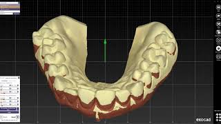 EXOCAD  Gingiva reduction guide design [upl. by Wendall]