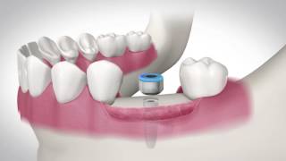 Implantes Dentales  ¿Cómo se pone un implante dental sin dolor [upl. by Ludovick746]