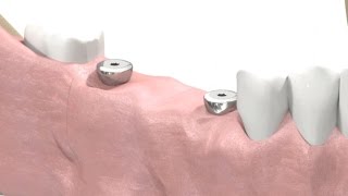 SIC invent Dental Implant  Prosthetic Animation BridgeWork Open Tray Technique [upl. by Panthia]