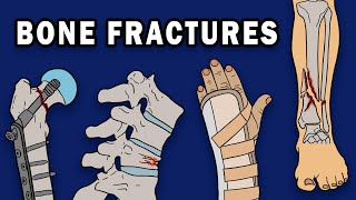 BONE FRACTURES [upl. by Eita]