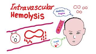 Intravascular Hemolysis [upl. by Ellehsim337]