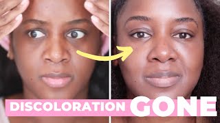 How I Got Rid of My Dark Circles Black Skin [upl. by Ahsiadal813]