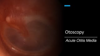 Acute Otitis Media Otoscopy [upl. by Irabaj]