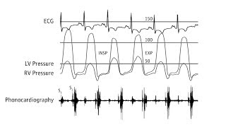 Pericardial Knock in Constrictive Pericarditis [upl. by Vachell]