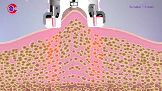 How Vacuum RF Fat Reduction Skin Tightening Treatment WorkSlimming Lymphatic Drainage Machine [upl. by Sherburn]