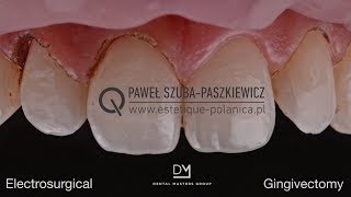 Electrosurgical Gingivectomy  Crown Lengthening [upl. by Anelleh]