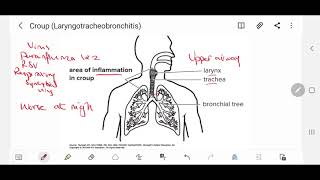 Croup Laryngotracheobronchitis Definition Presentation Management and detailed treatment [upl. by Kerekes]