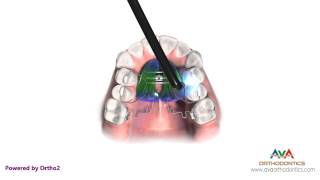 Orthodontic Space Management  Pendex Appliance [upl. by Asin]