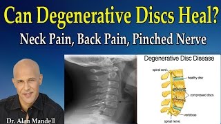 Can Degenerative Discs Heal Normal Again Neck Pain Back Pain Pinched Nerve  Dr Mandell [upl. by Ahter]