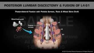 Posterior Lumbar Discectomy amp Fusion of L4S1 [upl. by Ahteral291]