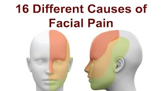 16 Causes of Facial Pain and Treatment Strategies [upl. by Akessej307]