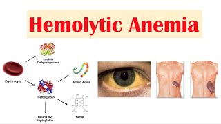 Hemolytic Anemia [upl. by Fonville]