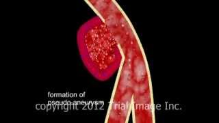 Pseudoaneurysm video  Animation by Cal Shipley MD Trial Image Inc [upl. by Solhcin981]