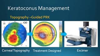 Keratoconus Management Corneal Crosslinking amp TopographyGuided PRK at Bochner Eye in Toronto [upl. by Desdamona375]