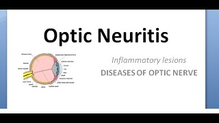 Ophthalmology Optic neuritis Papillitis NeuroRetinitis RetroBulbar phosphenes uhthoff pulfrich [upl. by Aryc]