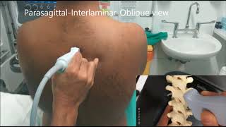 Realtime Ultrasound guided Thoracic epidural insertion [upl. by Htebazie65]