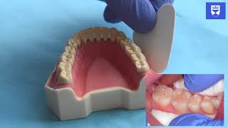 Technique for placing a resin fissure sealant [upl. by Yesdnyl]