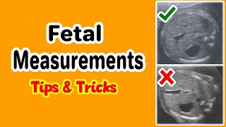 Fetal Measurements Tips and Tricks [upl. by Metah]