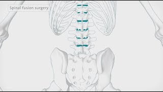 How back surgery spinal fusion is performed  Spire Healthcare [upl. by Enomal656]