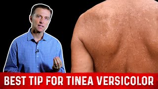 Natural Skin Fungus Tinea Versicolor Home Remedies – Dr Berg [upl. by Ttessil]