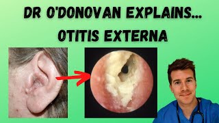 Explaining Otitis Externa  With Dr ODonovan [upl. by Oatis]