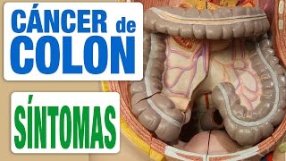 Cáncer de Colon  Síntomas [upl. by Eymaj]