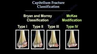 Capitellum Fracture Classification  Everything You Need To Know  Dr Nabil Ebraheim [upl. by Koziarz]