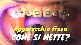 Come si mette lapparecchio fisso [upl. by Ovida641]