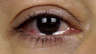 How To STOP EYES From WATERING  Top 5 Causes and Remedies For Watery Eyes [upl. by Ddet860]