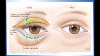 What is an Endoscopic Browlift [upl. by Solracesoj]