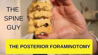 CERVICAL STENOSIS RADICULOPATHY  PART 4  THE POSTERIOR FORAMINOTOMY [upl. by Emearg]