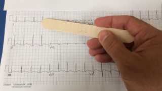 pericarditis on EKG [upl. by Hammock825]