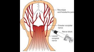 Occipital Nerve Block [upl. by Neliak]