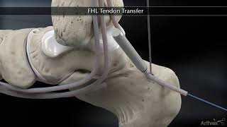 Flexor Hallucis Longus FHL Tendon Transfer [upl. by Pallaton676]