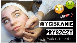 WYCISKANIE PRYSZCZY 😱💉 walka z trądzikiem 💪 [upl. by Alin]