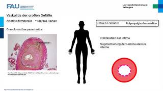 Leukocytoclastic Vasculitis ¦ Treatment and Symptoms [upl. by Aliuqat72]