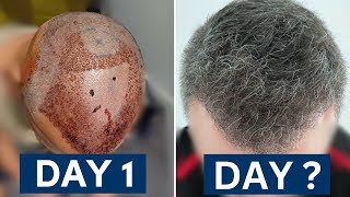 Healing Phase After Hair Transplant Faster Than Expected [upl. by Robena538]