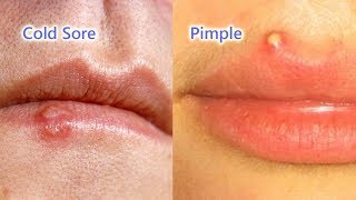 Why those tiny bumps AREN’T fungal acne [upl. by Argyle232]