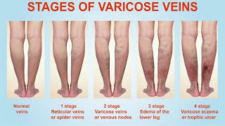 Varicose Vein Symptoms and Signs [upl. by Refanej]