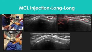 Knee Level 2 MCL Under Ultrasound [upl. by Enaamuj]