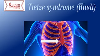 Teitze Syndrome hindi [upl. by Pyszka]