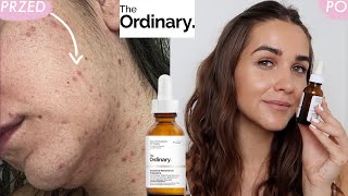 JAK POZBYŁAM SIE TRĄDZIKU  RETINOL z THE ORDINARY oczyścił moją skórę w 3 miesiące [upl. by Stasny103]